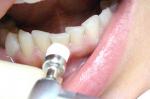 Что такое профессиональное отбеливание зубов?